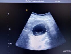Pengalaman Penuh Perjuangan Merawat Anak dengan CHARGE Syndrome