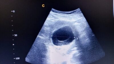 Pengalaman Penuh Perjuangan Merawat Anak dengan CHARGE Syndrome