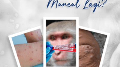 Penyebaran Cacar Monyet, Gejala, Penyebab, Berikut Tips untuk Pencegahannya Bersama RSUD Pandega Pangandaran