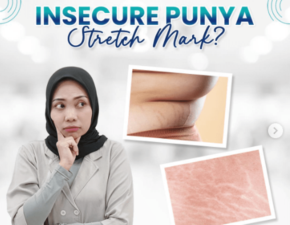 Memahami Penyebab dan Mengatasi Stretch Mark oleh dr. Gilang Dwipangestu RSUD Pandega Pangandaran