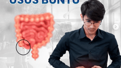 Yuk, Kenali Gejala Usus Buntu oleh Dokter Spesialis Bedah RSUD Pandega Pangandaran