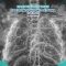 RSUD Pandega Pangandaran Peringati Hari Penyakit Obstruktif Kronis